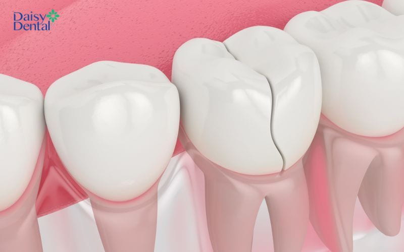 Răng lấy tủy có hiện tượng vỡ dọc