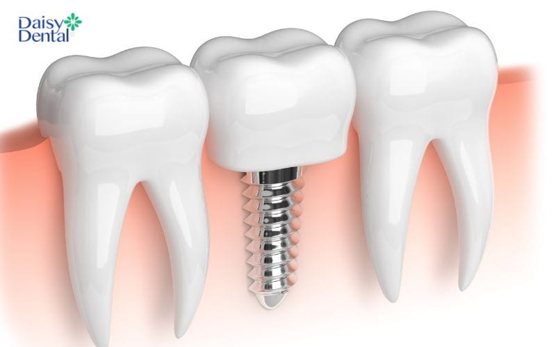 Trồng răng Implant cải thiện tình trạng răng lấy tủy bị vỡ