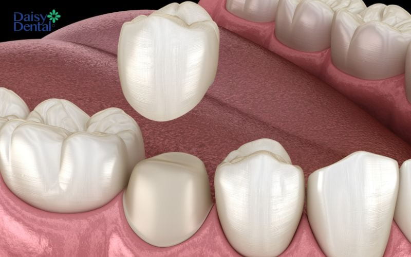 Phục hình răng lấy tủy bị vỡ bằng cách bọc răng sứ