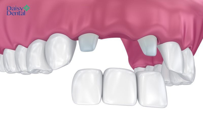 Làm cầu răng sứ giúp phục hình răng lấy tủy bị vỡ
