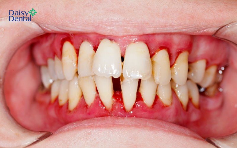 Viêm nha chu là tác nhân gây nên tình trạng sưng lợi răng cửa