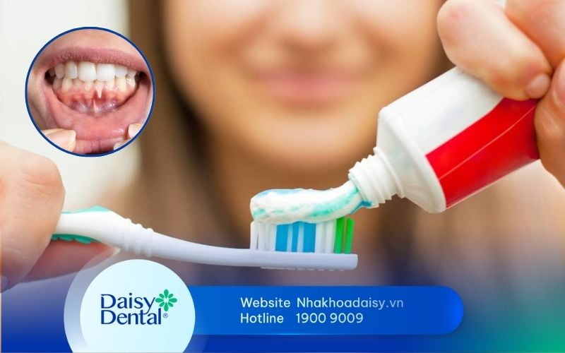 kem đánh răng cho người bị tụt lợi