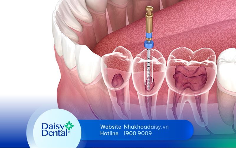 lấy tủy răng có được bảo hiểm không