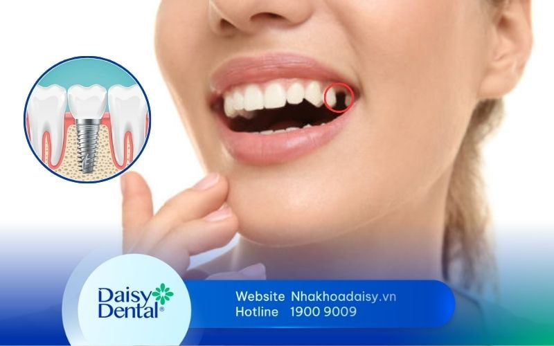 mất răng lâu năm có trồng Implant được không