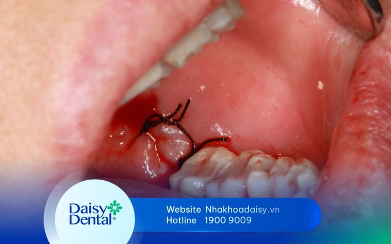 quá trình phục hồi sau khi nhổ răng khôn