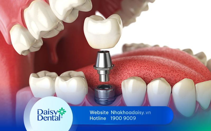 trồng răng Implant số 6