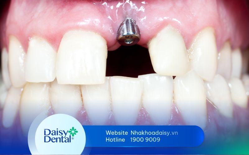 trồng răng Implant thất bại