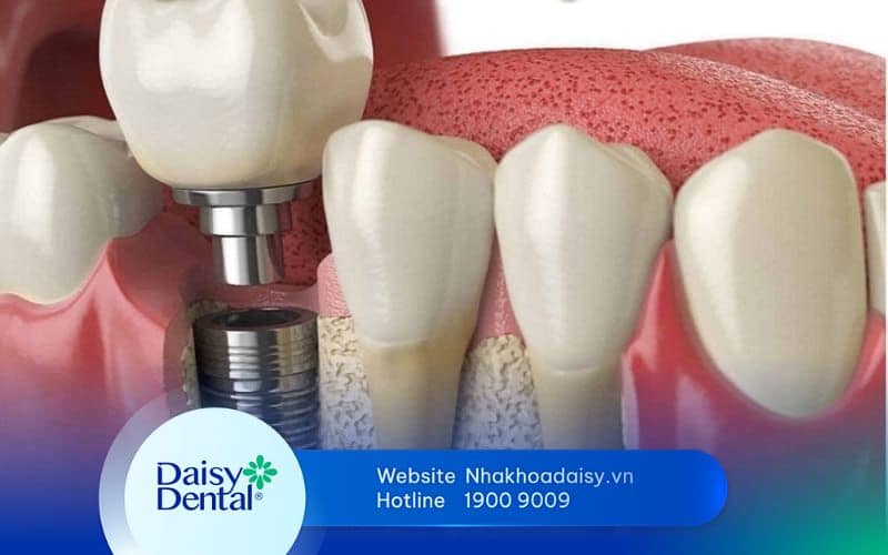 Trồng răng implant xi măng
