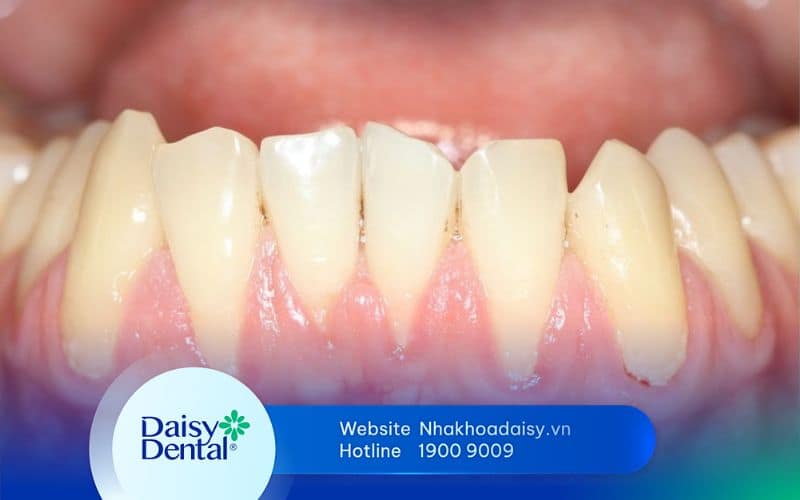 tụt lợi hàm dưới