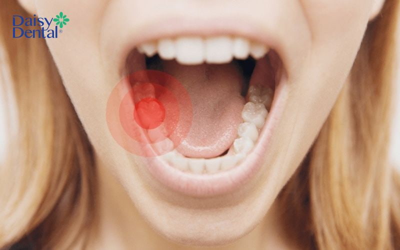 Tình trạng đau nhức sau khi lấy tủy răng