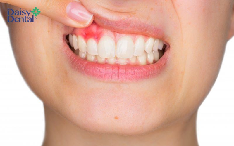 Tình trạng sưng nướu sau khi lấy tủy răng