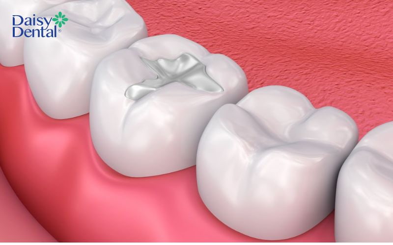 Trường hợp nhẹ có thể hàn trám lại răng