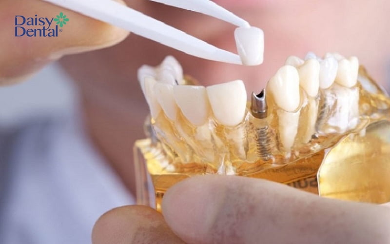 Bác sĩ nha khoa sẽ tiến hành lắp răng sứ lên trụ và kết thúc quá trình trồng răng