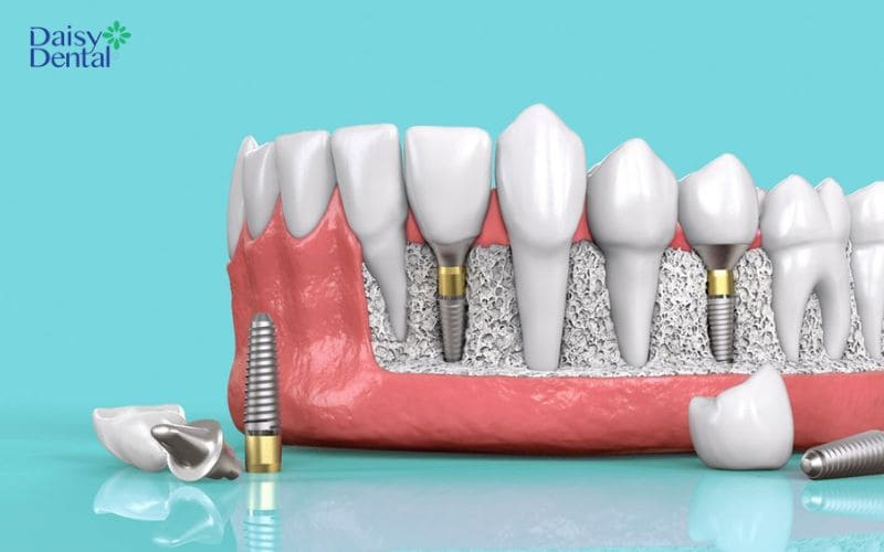 Trồng răng cấm giá bao nhiêu phụ thuộc vào tình trạng xương hàm nếu chọn phương pháp cấy ghép Implant