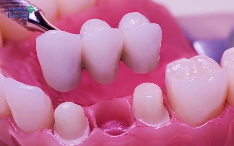 Phương pháp làm cầu răng sứ có chi phí phụ thuộc vào loại vật liệu sứ