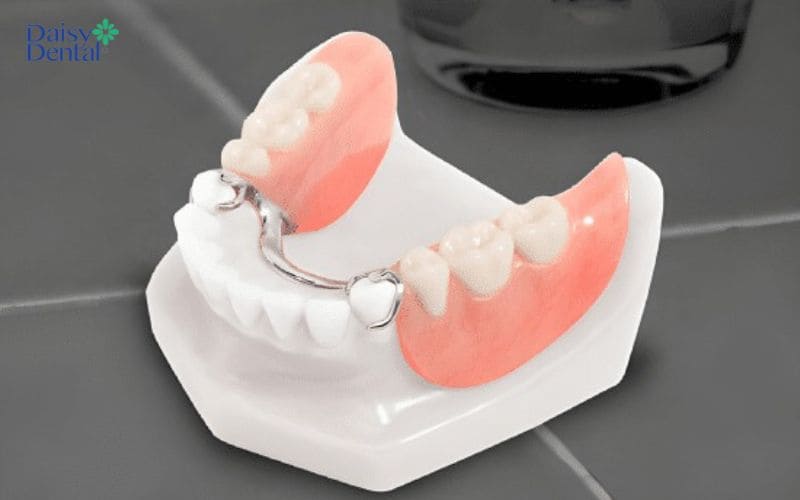 Phương pháp hàm giả tháo lắp có chi phí thấp nhưng không ngăn chặn được tình trạng tiêu xương hàm