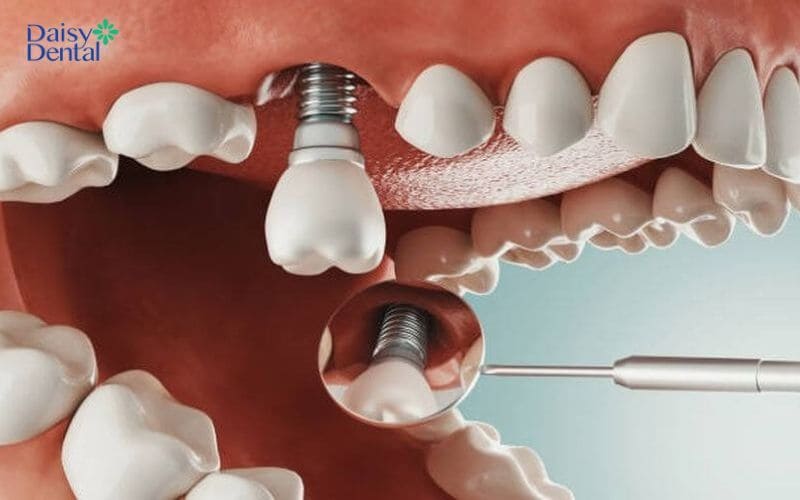 Trồng răng Implant là giải pháp tối ưu để phục hình răng cấm đã mất