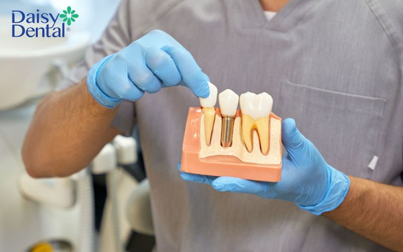 Trụ Implant có độ tương thích sinh học cao đảm bảo an toàn tuyệt đối cho cơ thể