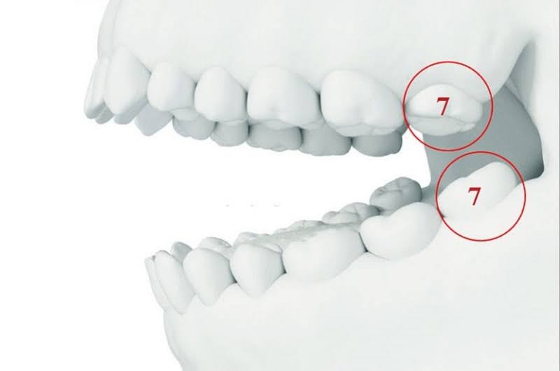 Răng số 7 là răng nằm ở vị trí trong cùng (nếu không có răng khôn).