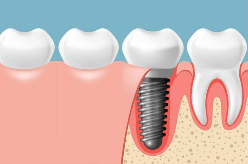 Nếu được chăm sóc đúng cách, răng Implant có thể bền đẹp trọn đời.