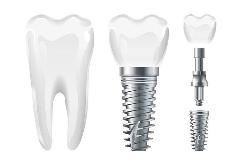 Trụ Implant được làm từ vật liệu an toàn trong nha khoa.