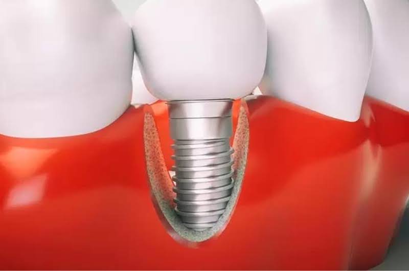 Phương pháp này không gây ảnh hưởng đến các răng bên cạnh.