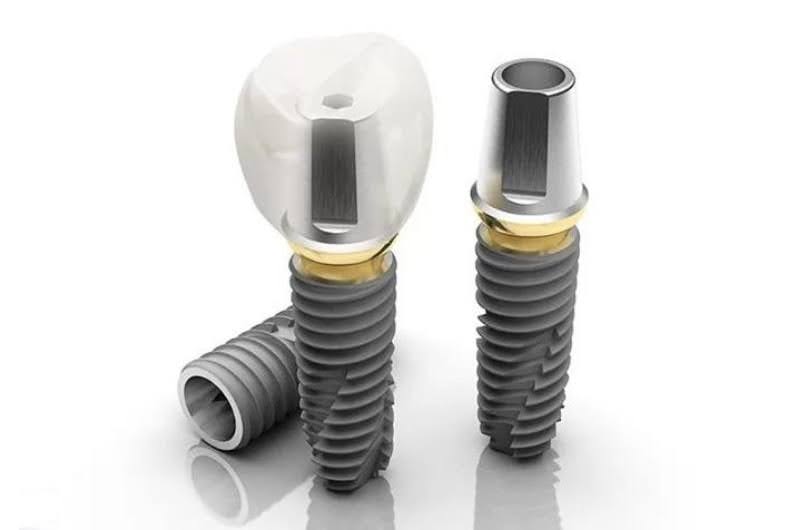 Tùy vào chất lượng trụ Implant và mão răng sứ mà chi phí cấy ghép Implant sẽ chênh lệch.