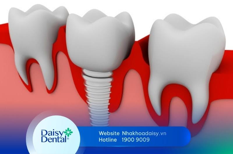 Trồng răng Implant số 7