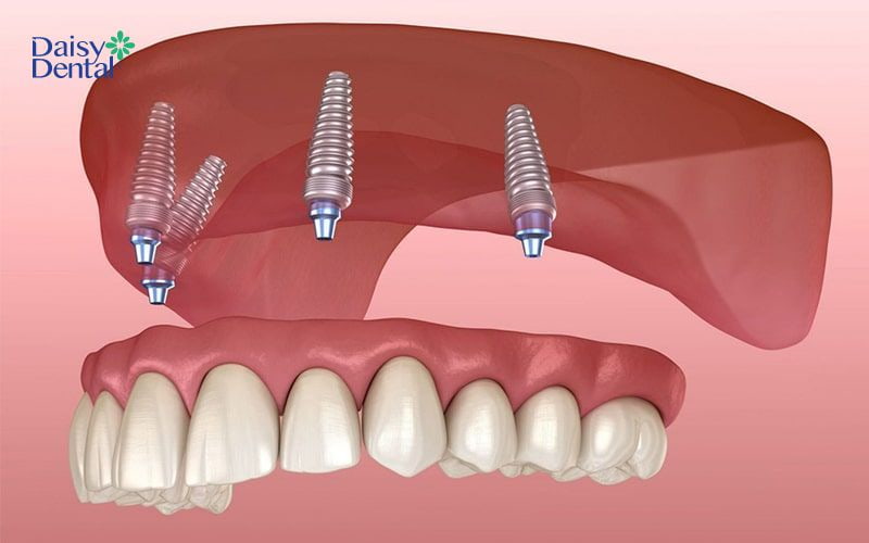 Đặt Implant lệch trục là nguyên nhân khiến việc cấy ghép răng giả thất bại