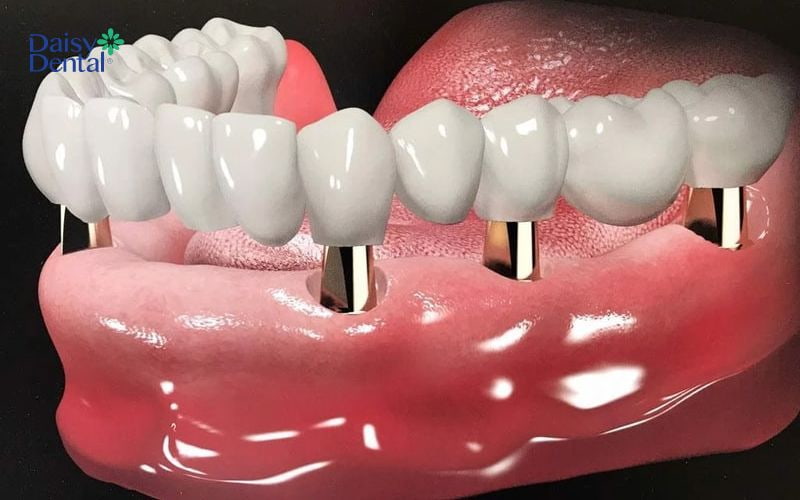 Sử dụng Implant kém chất lượng làm tăng tỷ lệ trồng răng giả không thành công