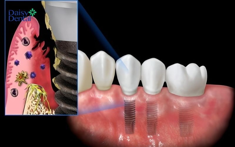 Trồng Implant thất bại dẫn đến nhiễm trùng