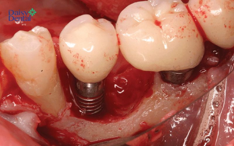 Trồng Implant không thành công có thể làm chảy máu kéo dài