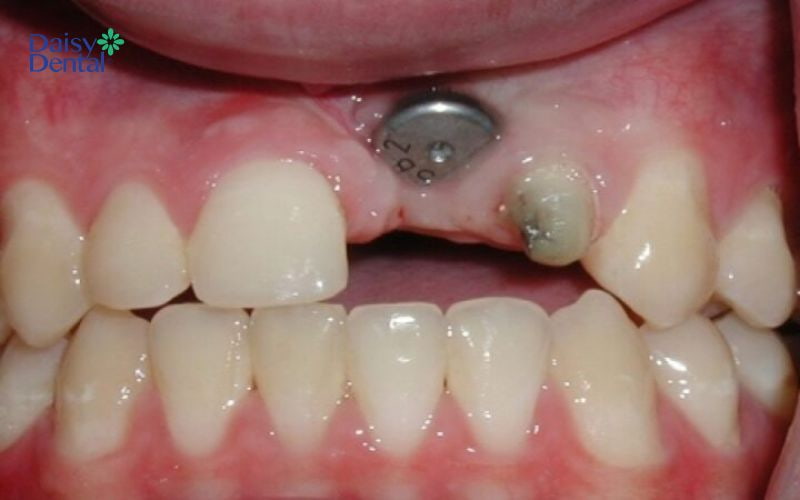 Trụ Implant cấy ghép thất bại sẽ làm tổn thương các dây thần kinh trong khoang miệng