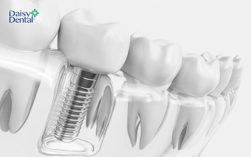 Bạn nên lựa chọn loại trụ Implant phù hợp với mình