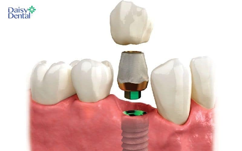 Răng implant xi măng được cấu tạo bởi trụ răng nhân tạo làm từ xi măng