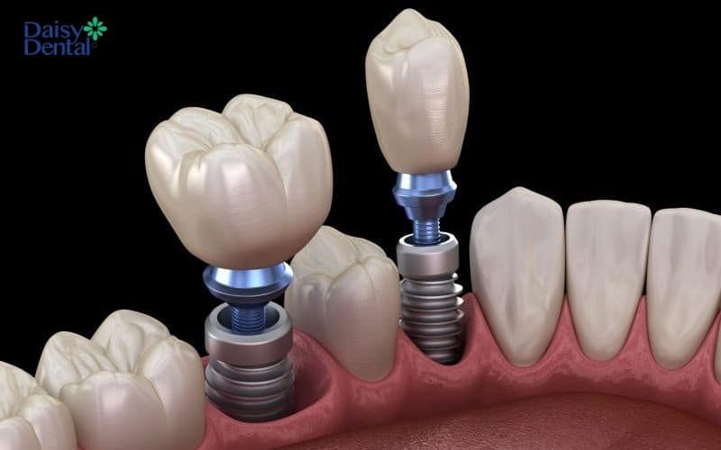 Trồng răng Implant bắt vít dễ dàng thay thế