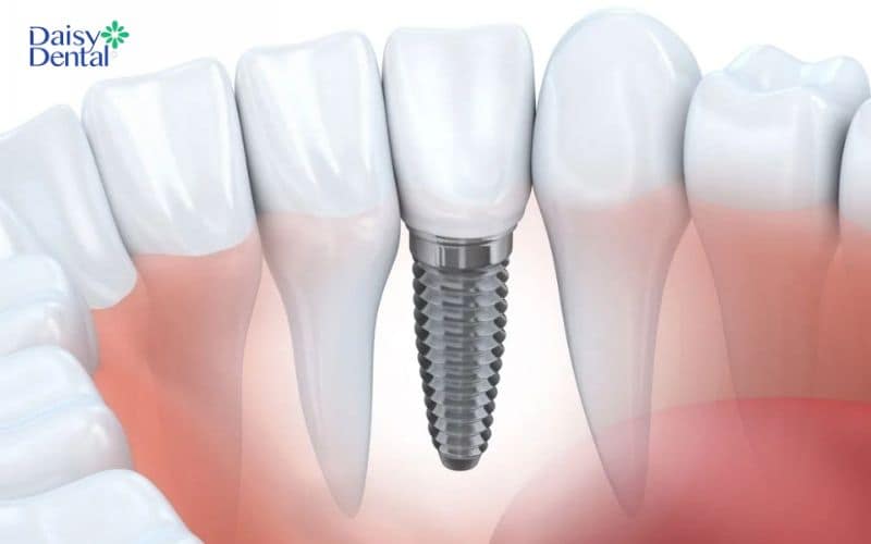 Trồng răng Implant xi măng có tính thẩm mỹ cao và hài hoà với các răng còn lại