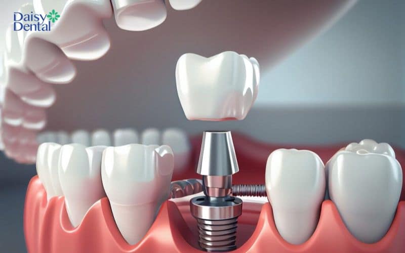 Trồng răng Implant bắt vít có tính linh hoạt cao và dễ thay thế