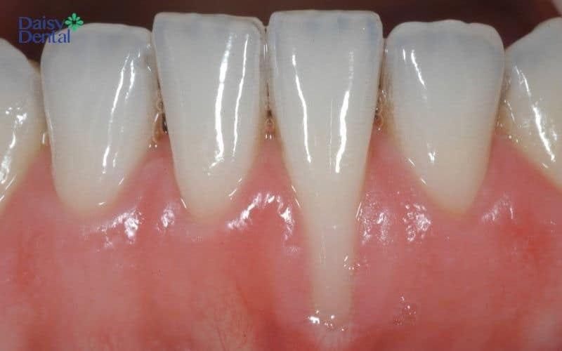Phần lợi của răng hàm dưới bị co rút dẫn đến lộ thân răng