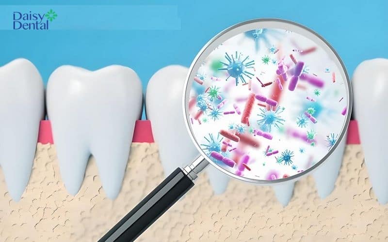 Kẽ răng không được làm sạch sẽ gây ra tụt lợi