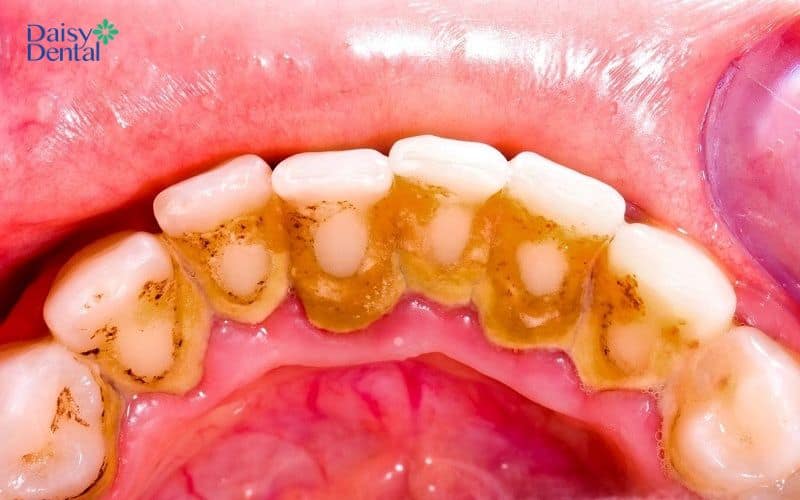 Không lấy cao răng định kỳ sẽ gây ra tình trạng tụt lợi hàm dưới