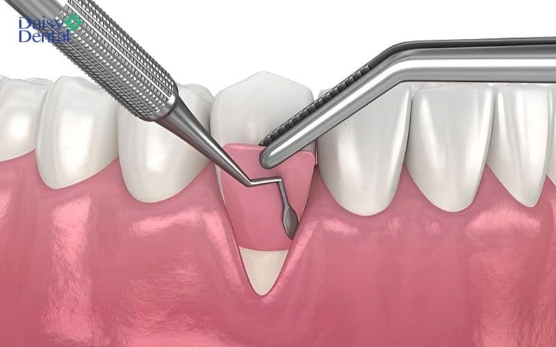 Có thể khắc phục tình trạng tụt lợi bằng cách ghép mô