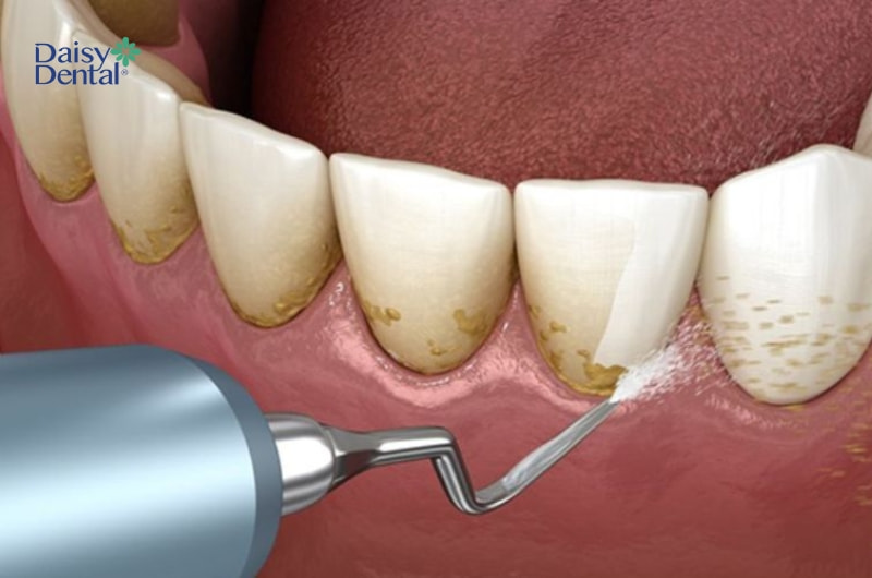 Răng bị sứt mẻ do va đập.