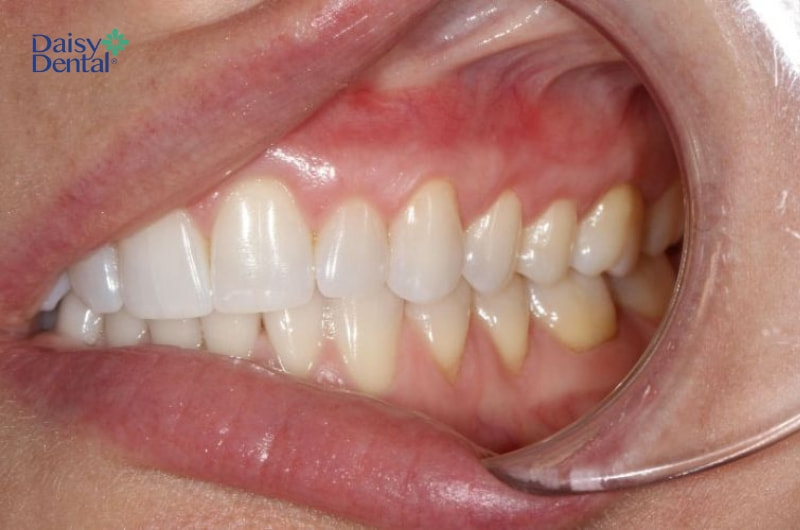 Tụt lợi nhẹ gây đau nhức.