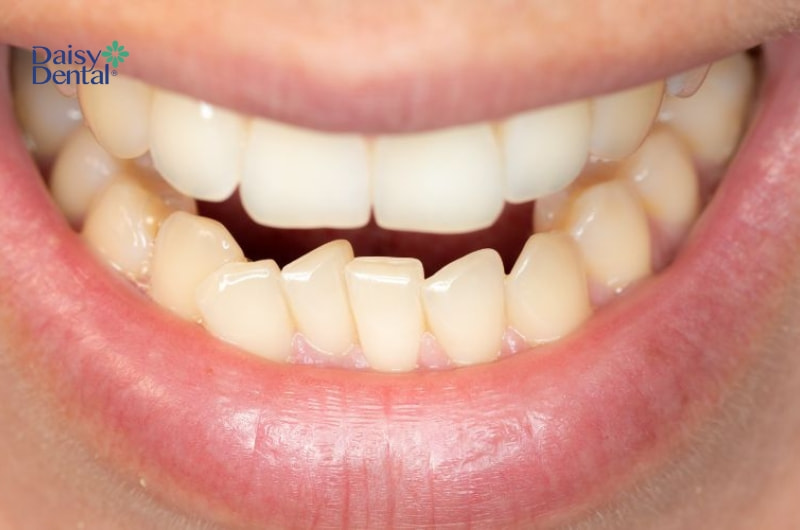 Súc miệng bằng nước muối ngăn chặn được tình trạng tụt lợi.