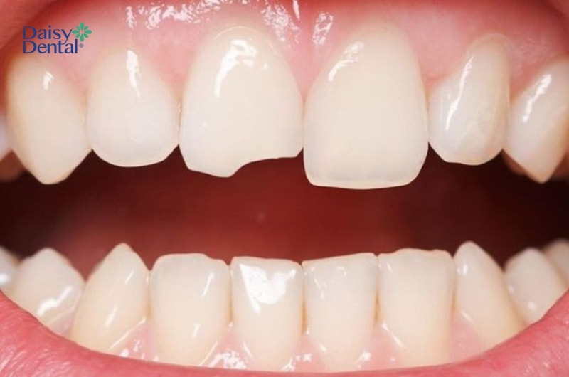 Cạo vôi răng khắc phục được tình trạng tụt lợi nhẹ.