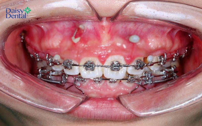Bật chân răng khi niềng do phản ứng tự nhiên của cơ thể khi răng dịch chuyển về vị trí mới trên cung hàm