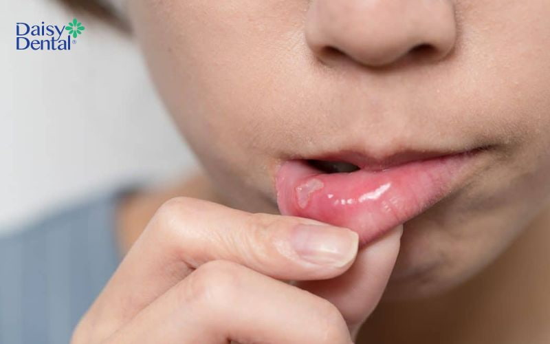 Mụn nước xuất hiện có thể do nhiệt miệng hoặc do bé cắn phải môi