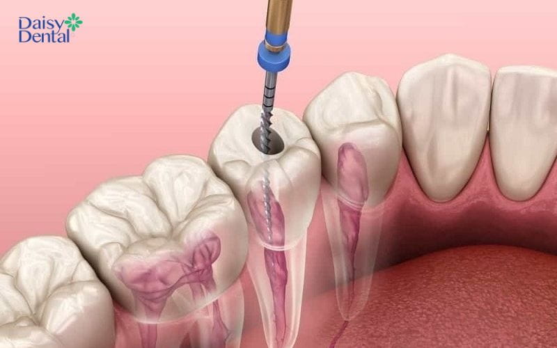 Sau khi lấy tủy độ bền của răng sẽ giảm