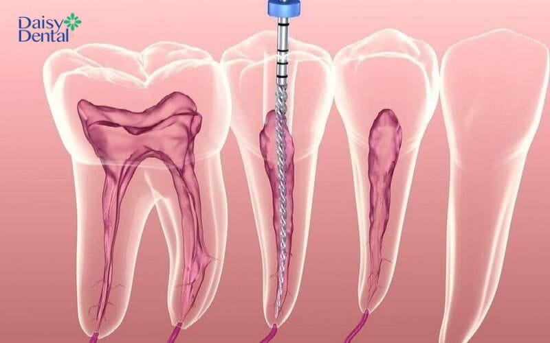 Sau khi lấy tủy răng sẽ dễ dàng bị vỡ hơn so với thông thường